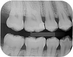 Radiografia Interproximal - Diagna Radiologia Odontológica Araguari