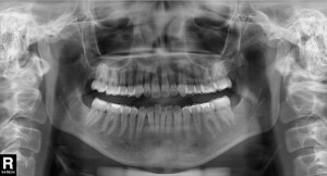 Radiografia Panorâmica - Diagna Radiologia Odontológica Araguari