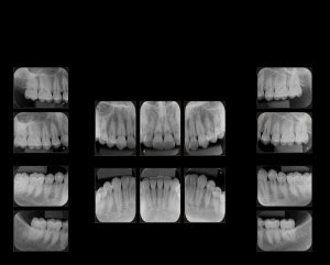 Periapical Completo - Diagna Radiologia Odontológica Araguari