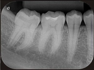 Periapical - Diagna Radiologia Odontológica Araguari