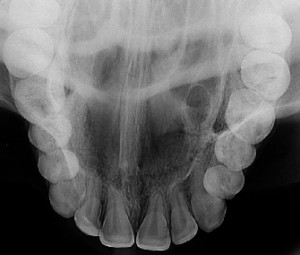Radiografia Oclusal - Diagna Radiologia Odontológica Araguari