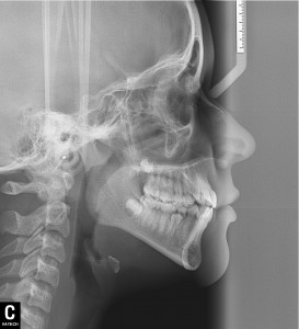 Telerradiografia Lateral - Diagna Radiologia Odontológica Araguari