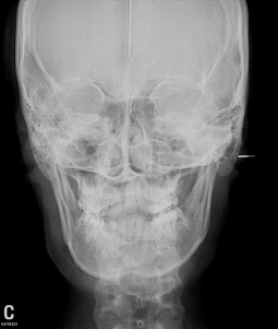 Telerradiografia Frontal - Diagna Radiologia Odontológica Araguari