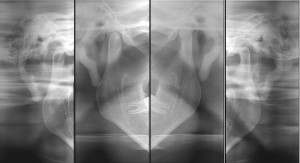 Articulação Têmporo-Mandibular (ATM) - Diagna Radiologia Odontológica Araguari